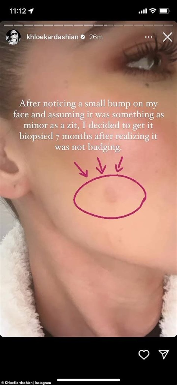 Khloe Kardashian Has Skin Cancer Scare, Tumor On Face Removed: Photos – Hollywood Life
