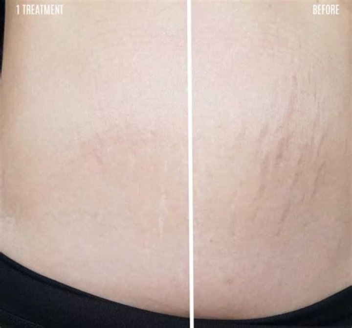 Lindsey Vonn Embraces ‘Cellulite & Stretch Marks’ After Body Image Issues: ‘Take It Or Leave It’